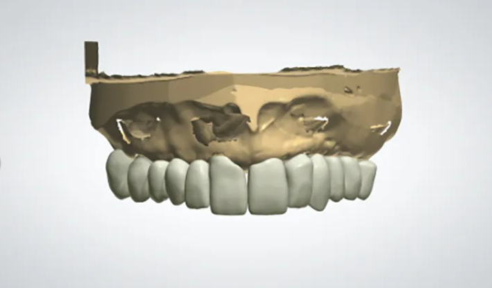 Dental Restorations with Digital Technology
